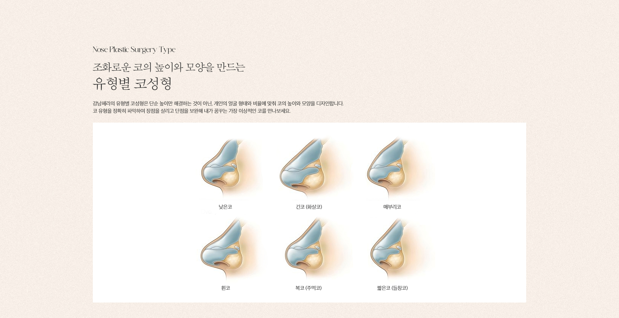 코성형