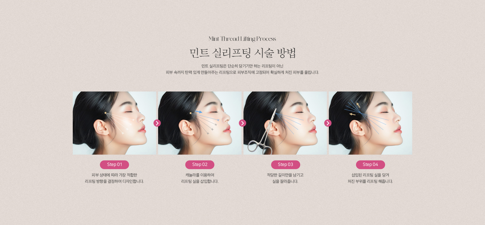 [민트 실리프팅 시술 방법] Step 01 : 피부 상태에 따라 가장 적합한 리프팅 방향을 결정하여 디자인합니다. / Step 02 : 캐뉼라를 이용하여 리프팅 실을 삽입합니다. / Step 03 : 적당한 길이만을 남기고 실을 잘라줍니다. / Step 04 : 삽입된 리프팅 실을 당겨 처진 부위를 리프팅 해줍니다.